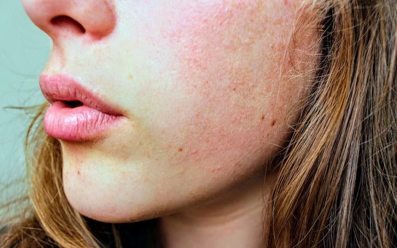 a woman with red blotchy skin